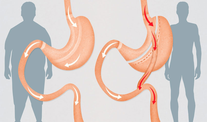 Баріатрична хірургія: як радикальне втручання змінює обмін речовин та життя