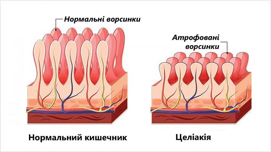 Целіакія: симптоми та лікування автоімунної реакції на злаковий білок